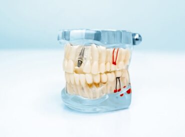 Dental,Implant.,Dentistry.,Prosthetics.,Transparent,Model,Of,Human,Teeth.,Layout Dental,Implant.,Dentistry.,Prosthetics.,Transparent,Model,Of,Human,Teeth.,Layout
