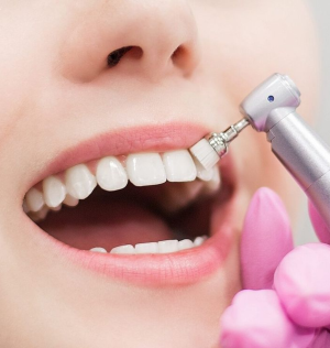 تنظيف الأسنان-مركز ميرال