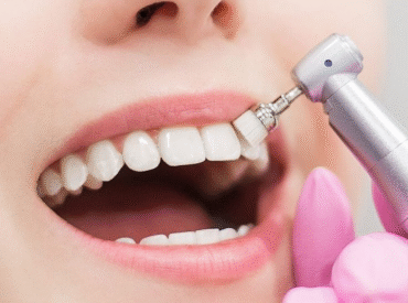 تنظيف الأسنان-مركز ميرال تنظيف الأسنان-مركز ميرال