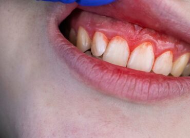 اسباب تورم اللثة اسباب تورم اللثة