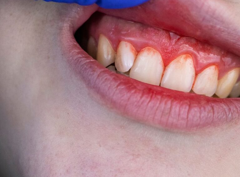 اسباب تورم اللثة