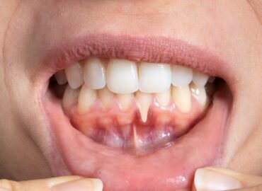 أسباب تورم اللثة ميرال لطب الاسنان أسباب تورم اللثة ميرال لطب الاسنان