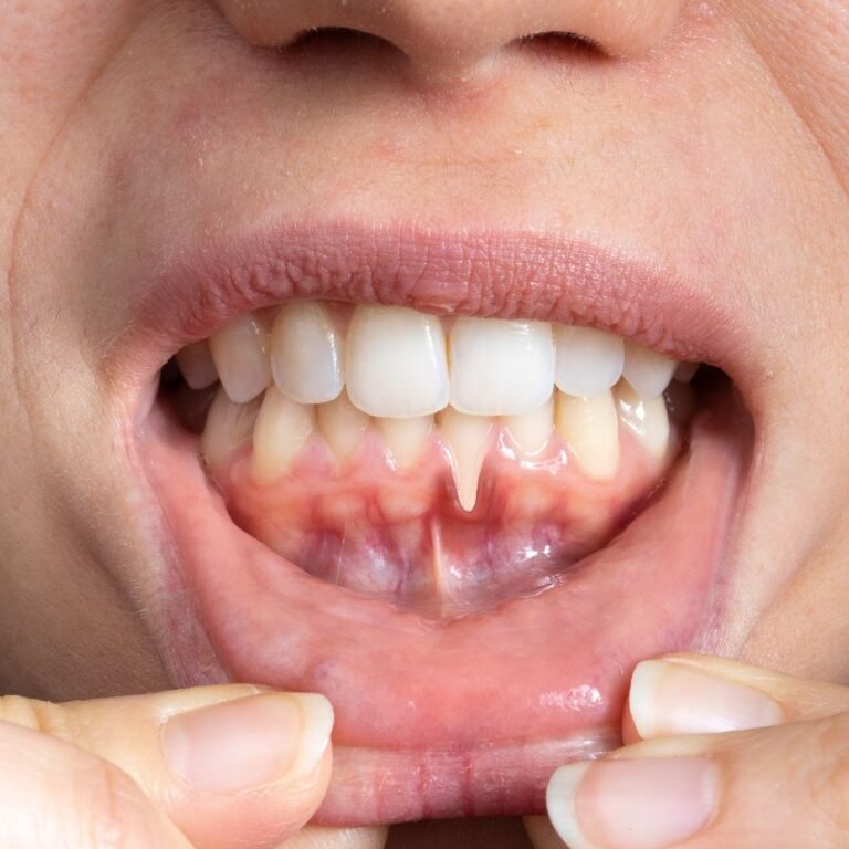 أسباب تورم اللثة ميرال لطب الاسنان