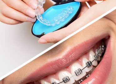 التقويم الشفاف والتقويم العادي