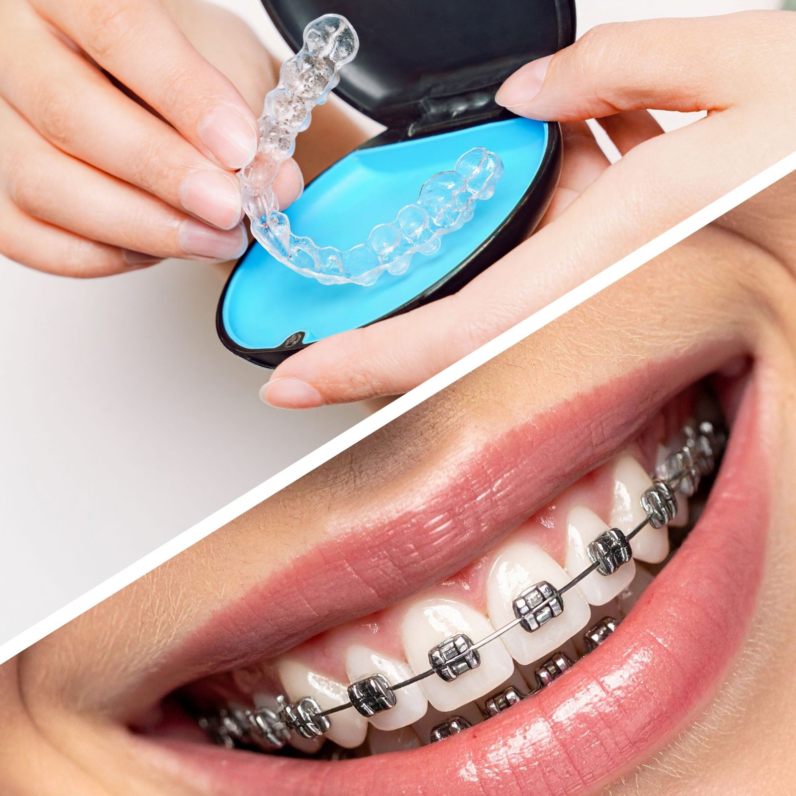 التقويم الشفاف والتقويم العادي