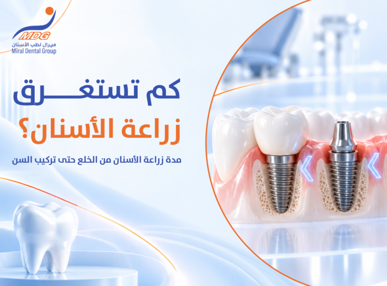 مدة زراعة الأسنان مدة زراعة الأسنان
